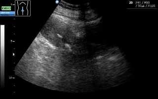 Причины образования кальцинатов в полости матки