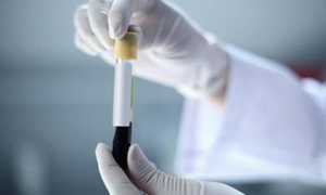 ЛГ (лютеинизирующий гормон) у женщин — норма, повышенный и пониженный