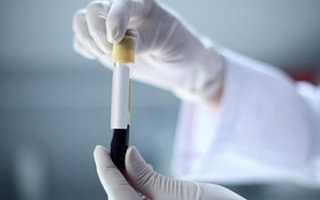 ЛГ (лютеинизирующий гормон) у женщин — норма, повышенный и пониженный