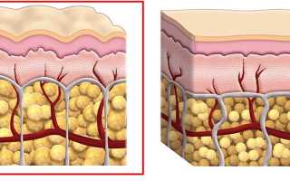 Как избавиться от целлюлита в домашних условиях на попе и ногах