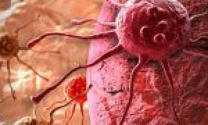 1, 2, 3, 4 стадия рака кожи — симптомы и подходы к лечению в зависимости от стадии