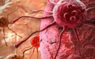 1, 2, 3, 4 стадия рака кожи — симптомы и подходы к лечению в зависимости от стадии