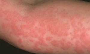 Крапивница аллергическая на коже: симптомы на фото, как лечить, диета или что можно есть?