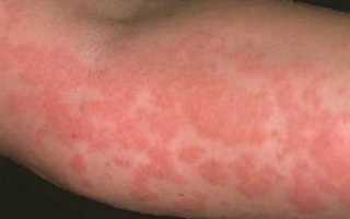 Крапивница аллергическая на коже: симптомы на фото, как лечить, диета или что можно есть?