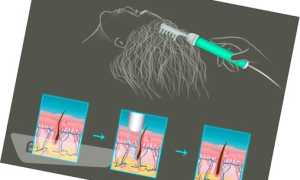 Аппарат Дарсонваль для волос и кожи головы: методика использования и показания к применению