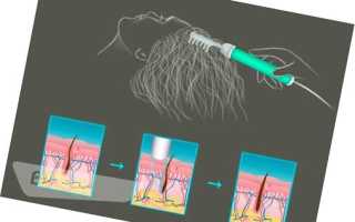 Аппарат Дарсонваль для волос и кожи головы: методика использования и показания к применению