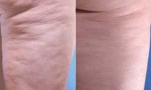 Ударно-волновая терапия (ударно-волновой липолиз)