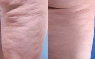 Ударно-волновая терапия (ударно-волновой липолиз)