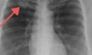 Симптомы центрального рака легких, его стадии, лечение и прогноз