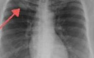 Симптомы центрального рака легких, его стадии, лечение и прогноз