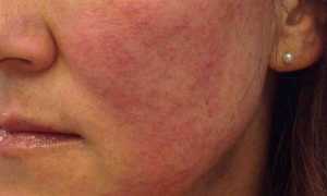 Красные шелушащиеся пятна на лице – как избавиться?