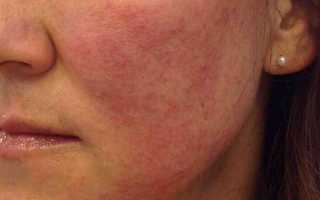 Красные шелушащиеся пятна на лице – как избавиться?