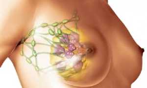 Как выявить и чем лечить диффузно-фиброзную мастопатию молочных желез?