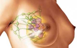 Как выявить и чем лечить диффузно-фиброзную мастопатию молочных желез?