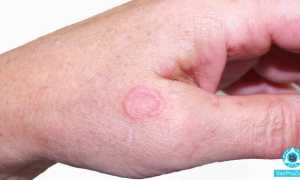 Чешется ли лишай у человека — описание, основные симптомы и способы лечения