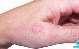 Чешется ли лишай у человека — описание, основные симптомы и способы лечения