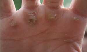 Мозоли на ногах: как избавиться от них народными методами или аптечными средствами и чем может помочь врач?