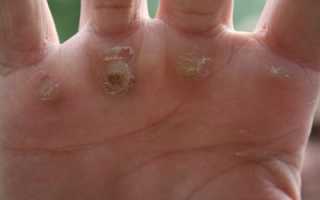 Мозоли на ногах: как избавиться от них народными методами или аптечными средствами и чем может помочь врач?