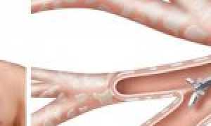 Внебольничная пневмония в начале ХХI века: плата за жизнь в большом городе