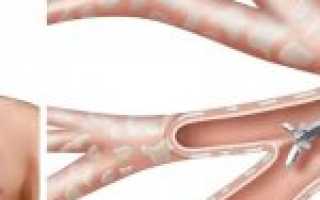 Внебольничная пневмония в начале ХХI века: плата за жизнь в большом городе