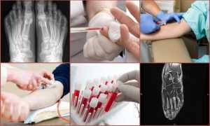 Почему болит сустав большого пальца ноги и как его лечить