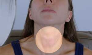 Гипотиреоз у женщин в менопаузе: симптомы и лечение