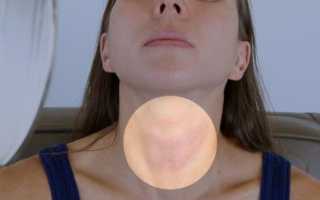 Гипотиреоз у женщин в менопаузе: симптомы и лечение