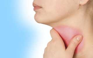 Особенности острого фарингита у взрослых. Как лечить заболевание?
