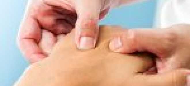 Синдром запястного канала (туннельный синдром): симптомы и лечение