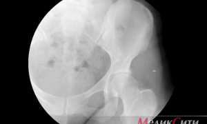 Спондилоартроз поясничного отдела позвоночника — что это такое и лечение +Фото