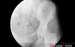 Спондилоартроз поясничного отдела позвоночника — что это такое и лечение +Фото