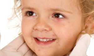 Сыпь при энтеровирусной инфекции у детей: фото, лечение