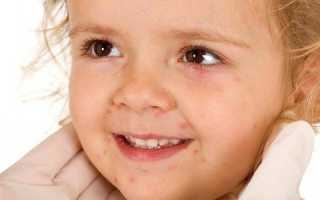 Сыпь при энтеровирусной инфекции у детей: фото, лечение