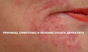 Различные виды дерматита — симптомы, правила лечения