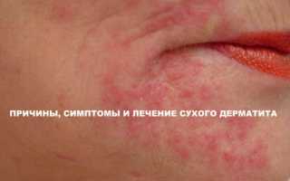 Различные виды дерматита — симптомы, правила лечения
