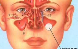 Киста верхнечелюстной пазухи: причины и лечение, симптомы, размеры для удаления