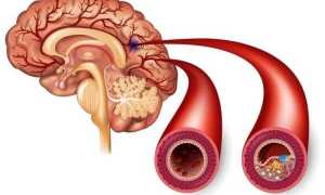 Хроническая ишемия головного мозга: симптомы в зависимости от степени (1-2-3), причины, лечение и прогноз
