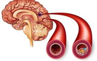 Хроническая ишемия головного мозга: симптомы в зависимости от степени (1-2-3), причины, лечение и прогноз