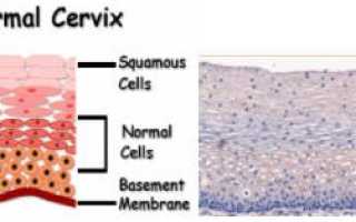 Скрининг на рак шейки матки: Что это, кто должен это делать и как часто?